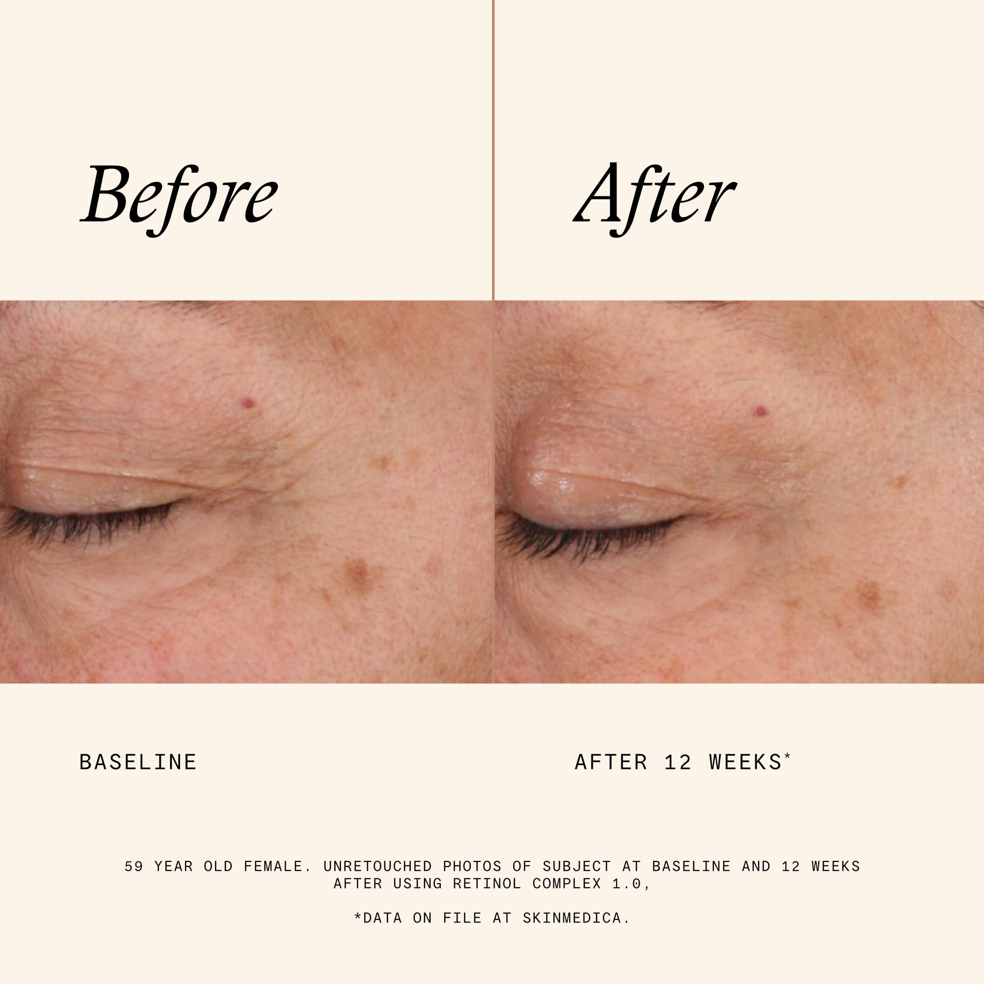 SkinMedica Retinol Serum 1.0 Complex - Serum for Face, Age-Defying Advanced Retinol Cream That Renews Skin and Diminishes