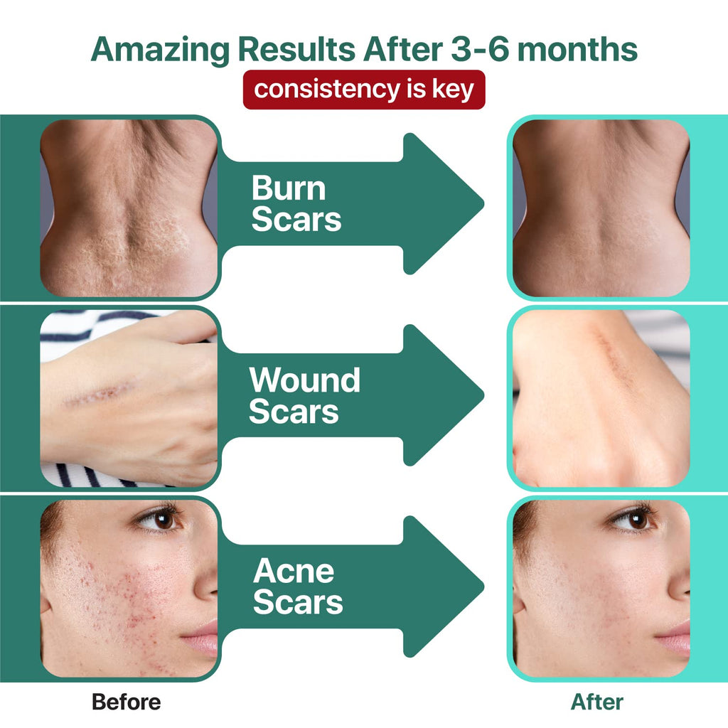 Ebanel Bundle of Advanced Silicone Scar Gel 1 Oz, and Hyaluronic Acid Serum