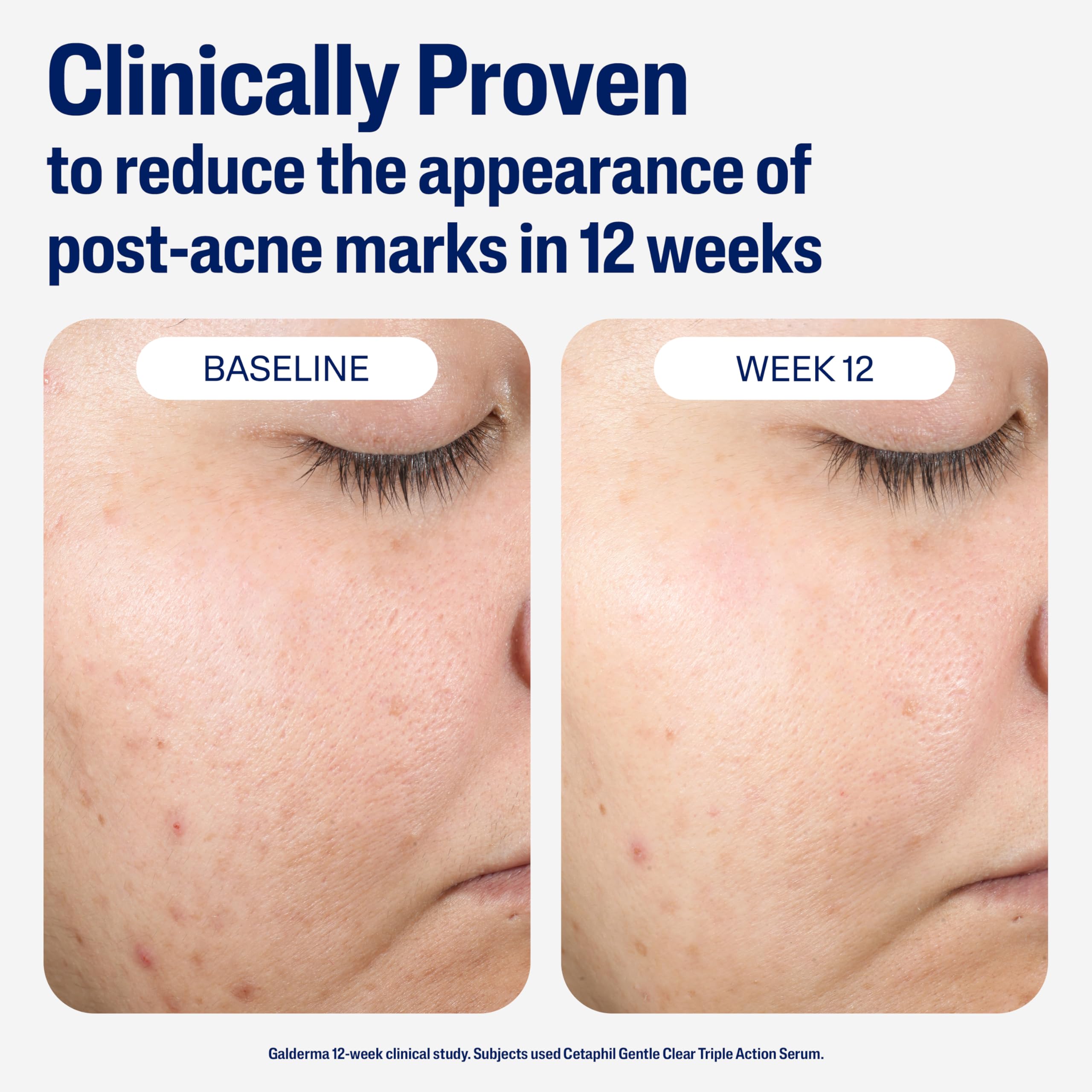 CETAPHIL Gentle Clear Repairing Post-Acne Serum, Retinol Alternative, Oil Free Serum for Sensitive Skin, 1 Fl Oz, Bakuchiol, Improves Skin Tone & Post-acne Marks,